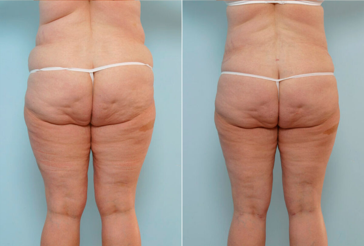 Abdominoplasty before and after photos in Houston, TX, Patient 34630