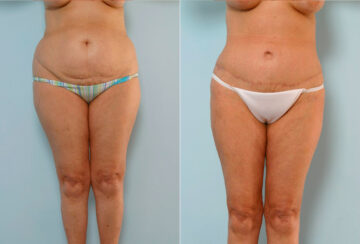 Tummy Tuck/Abdominoplasty before and after photos in Houston, TX, Patient 34647