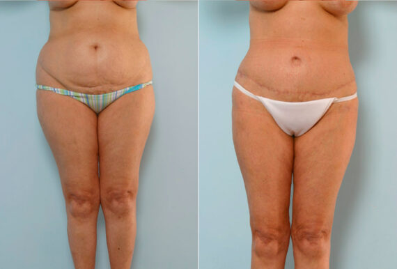 Abdominoplasty before and after photos in Houston, TX, Patient 34647