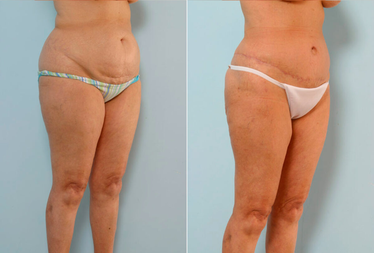 Abdominoplasty before and after photos in Houston, TX, Patient 34647