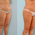 Abdominoplasty before and after photos in Houston, TX, Patient 34647