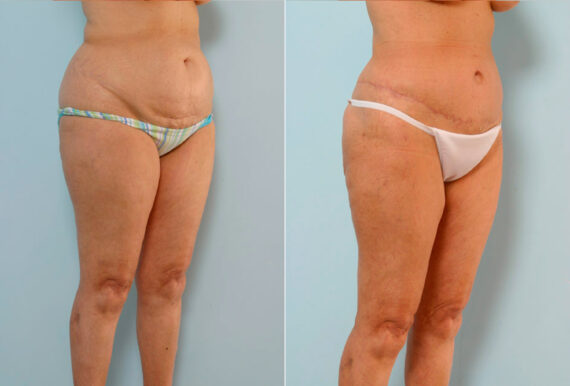 Tummy Tuck/Abdominoplasty before and after photos in Houston, TX, Patient 34647