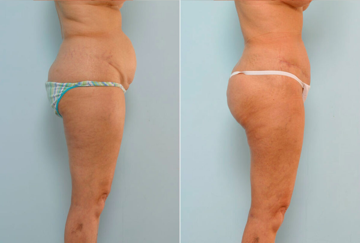 Abdominoplasty before and after photos in Houston, TX, Patient 34647