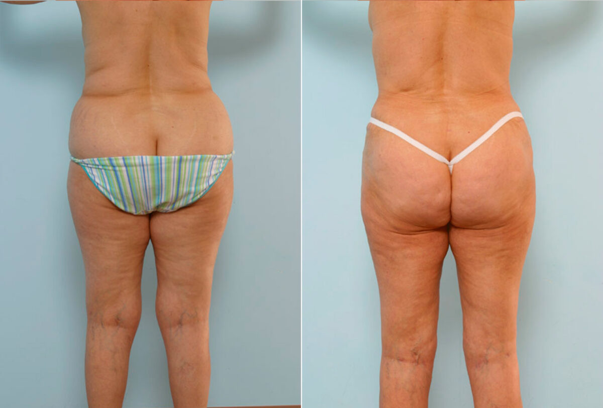 Abdominoplasty before and after photos in Houston, TX, Patient 34647