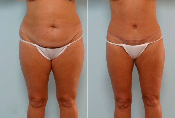 Abdominoplasty before and after photos in Houston, TX, Patient 34660