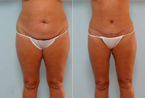 Tummy Tuck/Abdominoplasty before and after photos in Houston, TX, Patient 34660