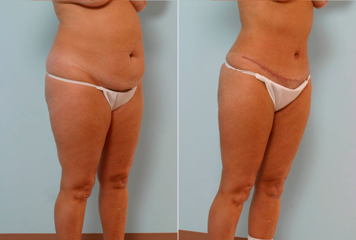 Tummy Tuck/Abdominoplasty before and after photos in Houston, TX, Patient 34660