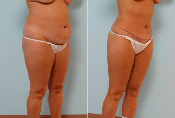 Tummy Tuck/Abdominoplasty before and after photos in Houston, TX, Patient 34660