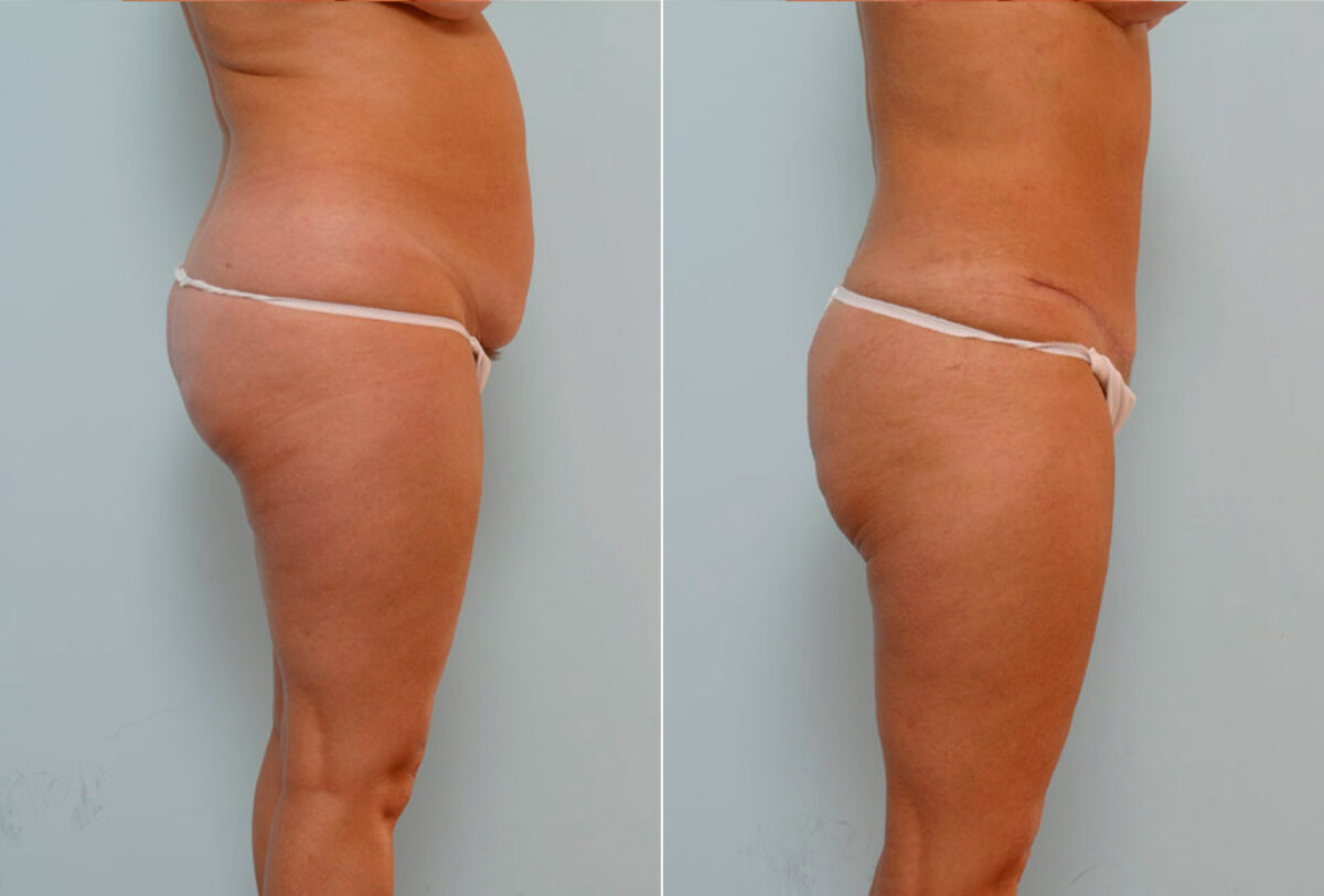 Abdominoplasty before and after photos in Houston, TX, Patient 34660