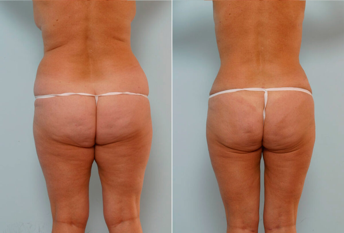 Abdominoplasty before and after photos in Houston, TX, Patient 34660