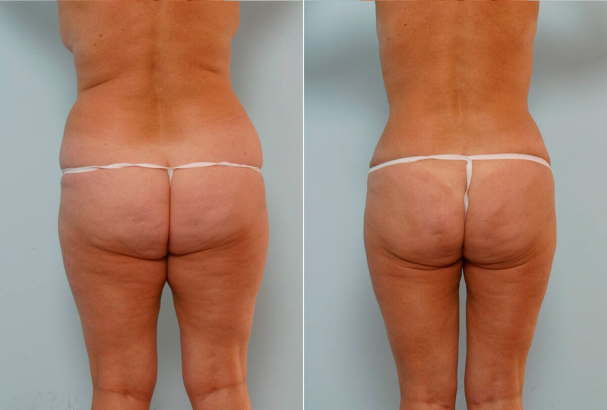 Tummy Tuck/Abdominoplasty before and after photos in Houston, TX, Patient 34660