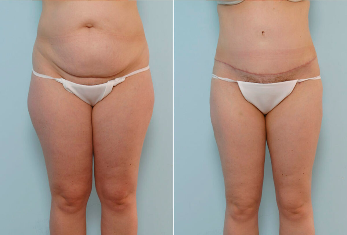 Abdominoplasty before and after photos in Houston, TX, Patient 34673