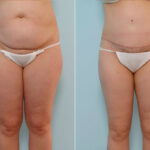 Abdominoplasty before and after photos in Houston, TX, Patient 34673