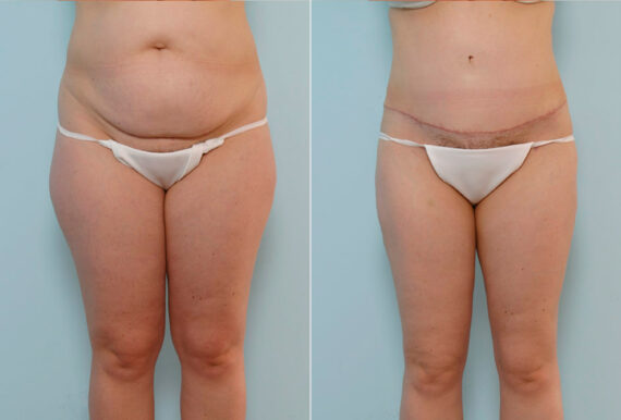 Tummy Tuck/Abdominoplasty before and after photos in Houston, TX, Patient 34673