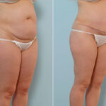 Abdominoplasty before and after photos in Houston, TX, Patient 34673