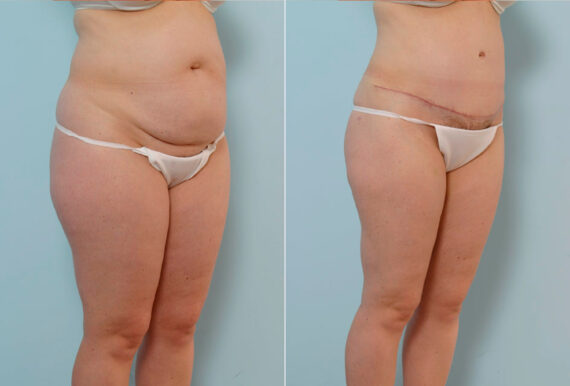 Abdominoplasty before and after photos in Houston, TX, Patient 34673