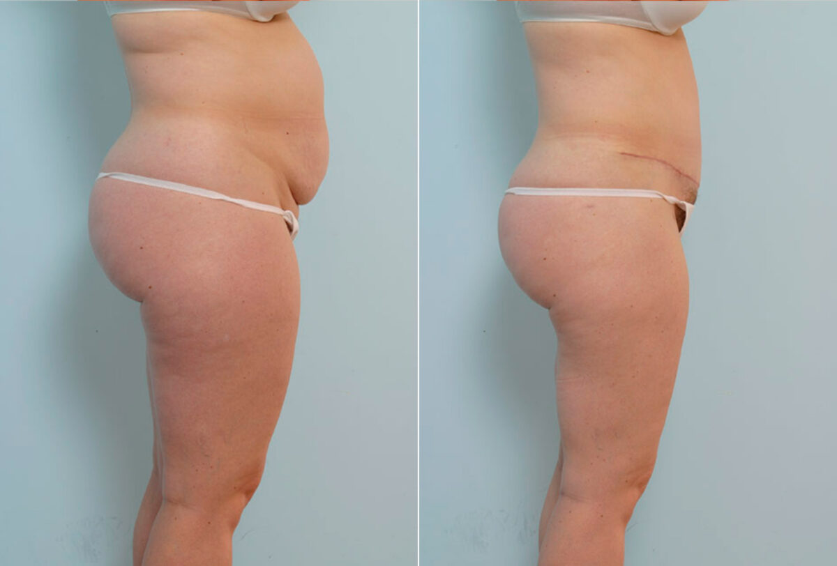 Abdominoplasty before and after photos in Houston, TX, Patient 34673