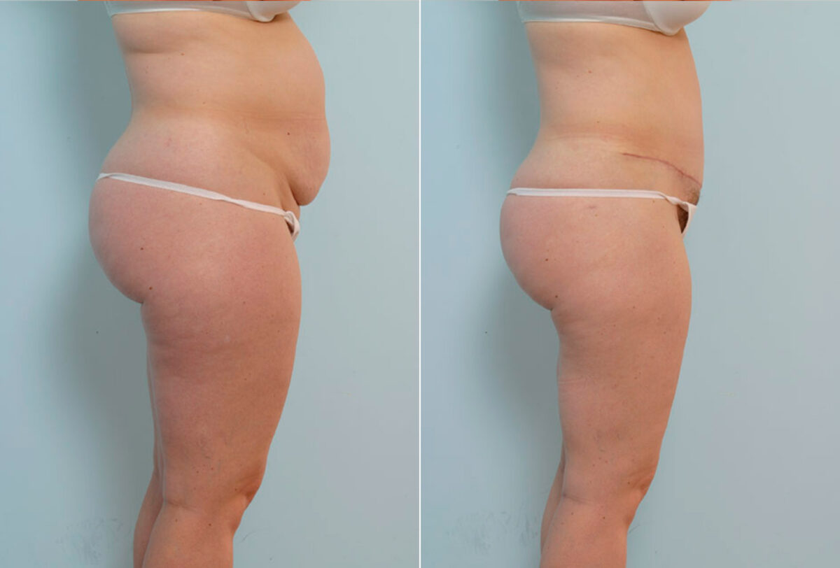 Tummy Tuck/Abdominoplasty before and after photos in Houston, TX, Patient 34673