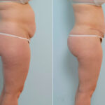 Abdominoplasty before and after photos in Houston, TX, Patient 34673