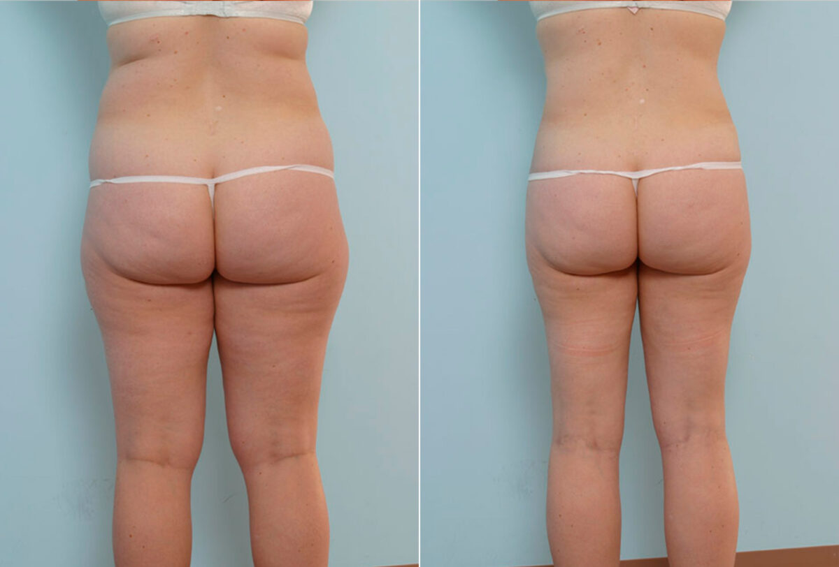 Abdominoplasty before and after photos in Houston, TX, Patient 34673