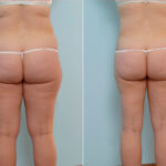 Abdominoplasty before and after photos in Houston, TX, Patient 34673