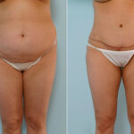 Abdominoplasty before and after photos in Houston, TX, Patient 24252