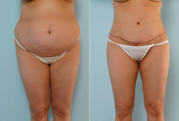 Tummy Tuck/Abdominoplasty before and after photos in Houston, TX, Patient 24252