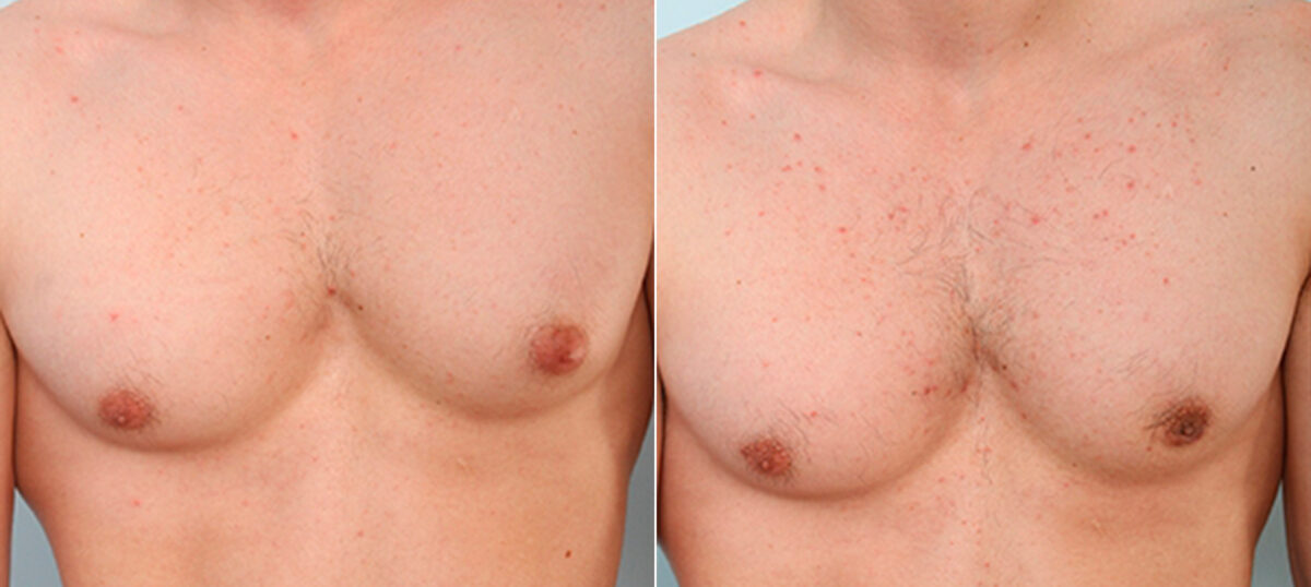 Gynecomastia (Male Breast Reduction) before and after photos in Houston, TX, Patient 34748