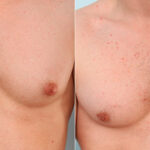 Gynecomastia (Male Breast Reduction) before and after photos in Houston, TX, Patient 34748