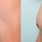 Gynecomastia (Male Breast Reduction) before and after photos in Houston, TX, Patient 34748