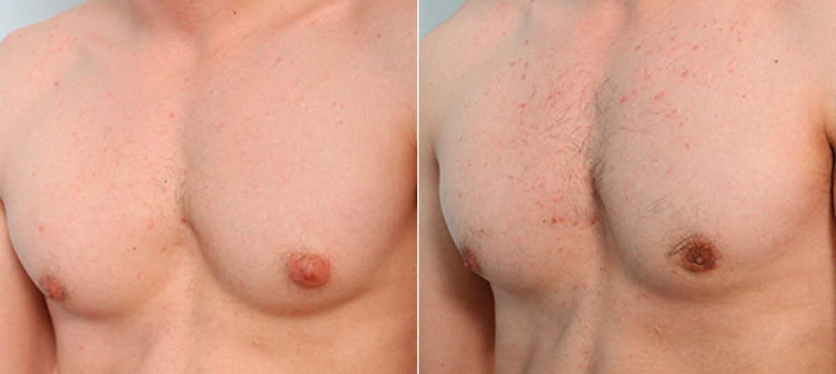 Gynecomastia (Male Breast Reduction) before and after photos in Houston, TX, Patient 34748