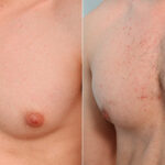 Gynecomastia (Male Breast Reduction) before and after photos in Houston, TX, Patient 34748