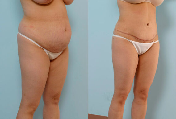 Tummy Tuck/Abdominoplasty before and after photos in Houston, TX, Patient 24252