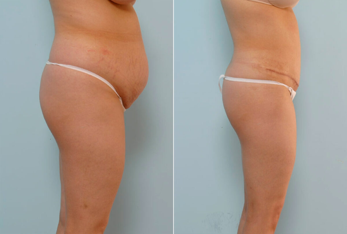 Abdominoplasty before and after photos in Houston, TX, Patient 24252