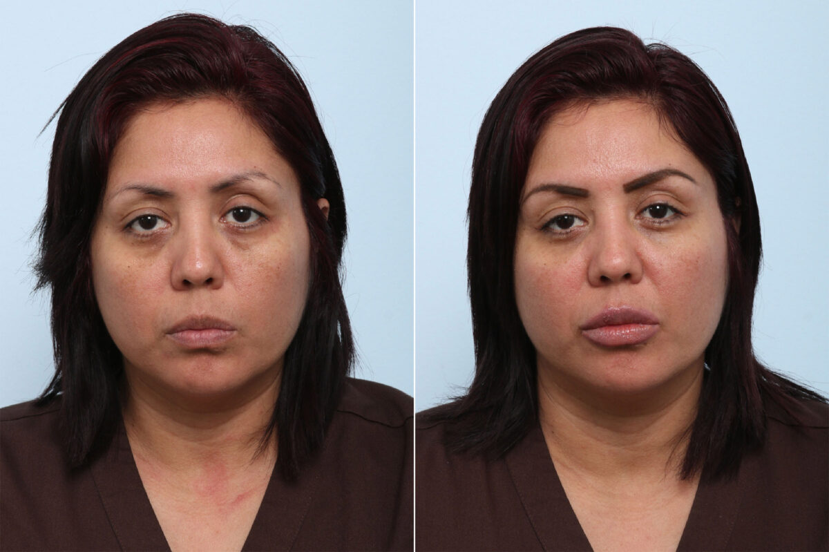 Juvederm Voluma XC before and after photos in Houston, TX, Patient 42584