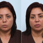 Juvederm Voluma XC before and after photos in Houston, TX, Patient 42584