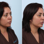 Juvederm Voluma XC before and after photos in Houston, TX, Patient 42584