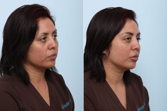 Juvederm Voluma XC before and after photos in Houston, TX, Patient 42584