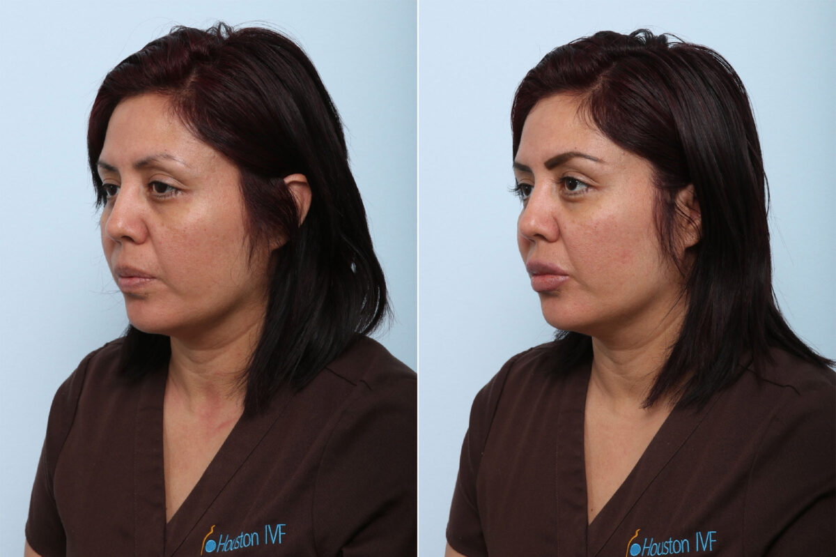 Juvederm Voluma XC before and after photos in Houston, TX, Patient 42584