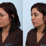 Juvederm Voluma XC before and after photos in Houston, TX, Patient 42584