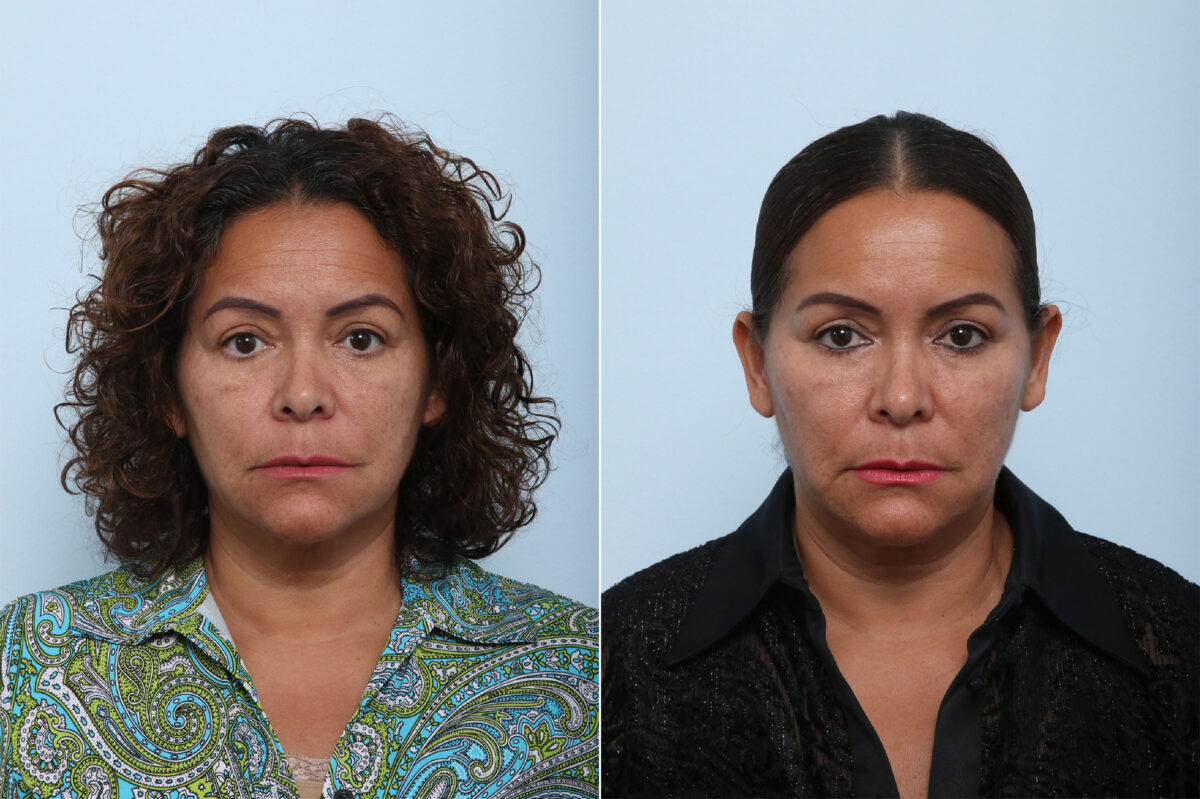 Juvederm Voluma XC before and after photos in Houston, TX, Patient 42597