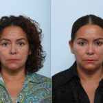 Juvederm Voluma XC before and after photos in Houston, TX, Patient 42597