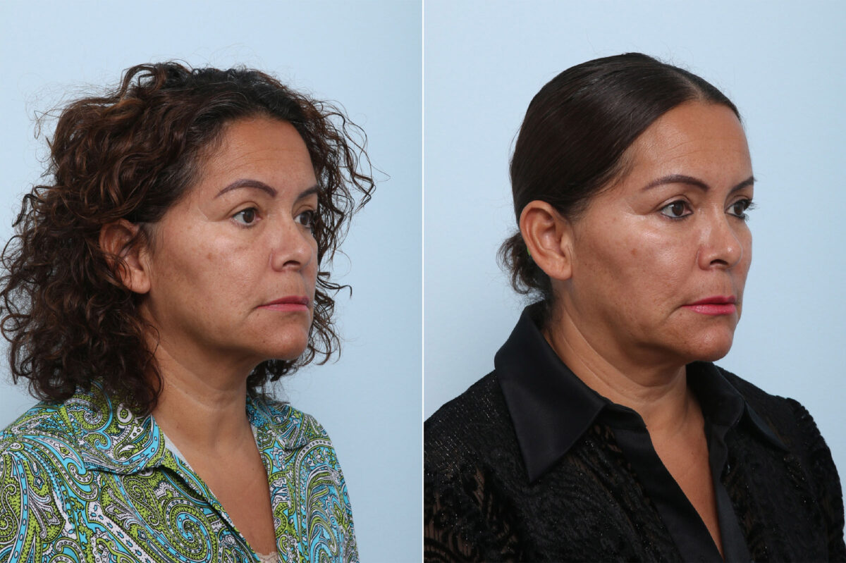 Juvederm Voluma XC before and after photos in Houston, TX, Patient 42597