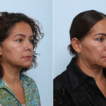 Juvederm Voluma XC before and after photos in Houston, TX, Patient 42597