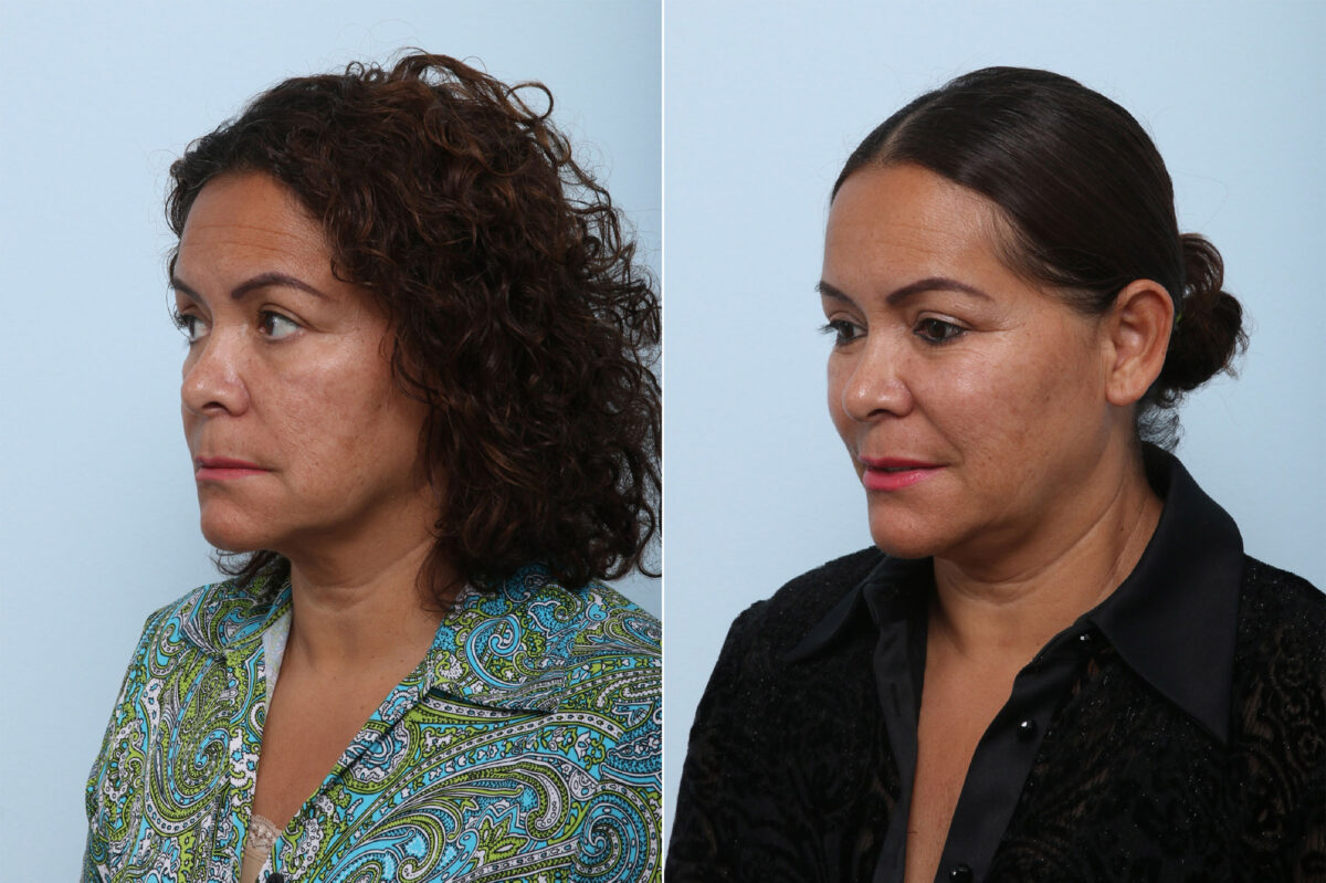 Juvederm Voluma XC before and after photos in Houston, TX, Patient 42597