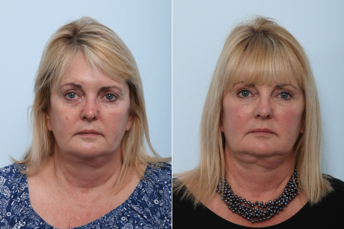 Juvederm Voluma XC before and after photos in Houston, TX, Patient 42610