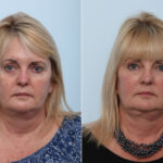 Juvederm Voluma XC before and after photos in Houston, TX, Patient 42610