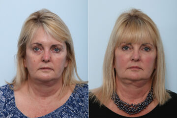 Juvederm Voluma XC before and after photos in Houston, TX, Patient 42610