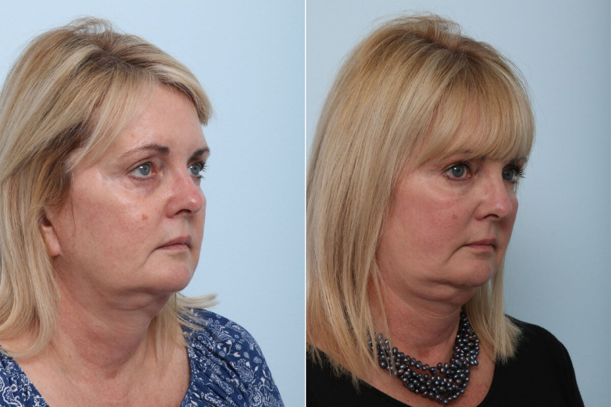 Juvederm Voluma XC before and after photos in Houston, TX, Patient 42610