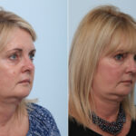 Juvederm Voluma XC before and after photos in Houston, TX, Patient 42610